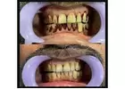Teeth Whiting in Dhakuria