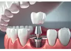 Best Clinic for Dental Implant in Katong