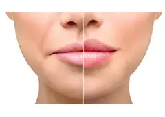 Best Service For Dermal Fillers in Hornchurch