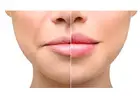 Best Service For Dermal Fillers in Hornchurch