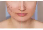 Best Treatment For Acne Scarring in Spitalfields